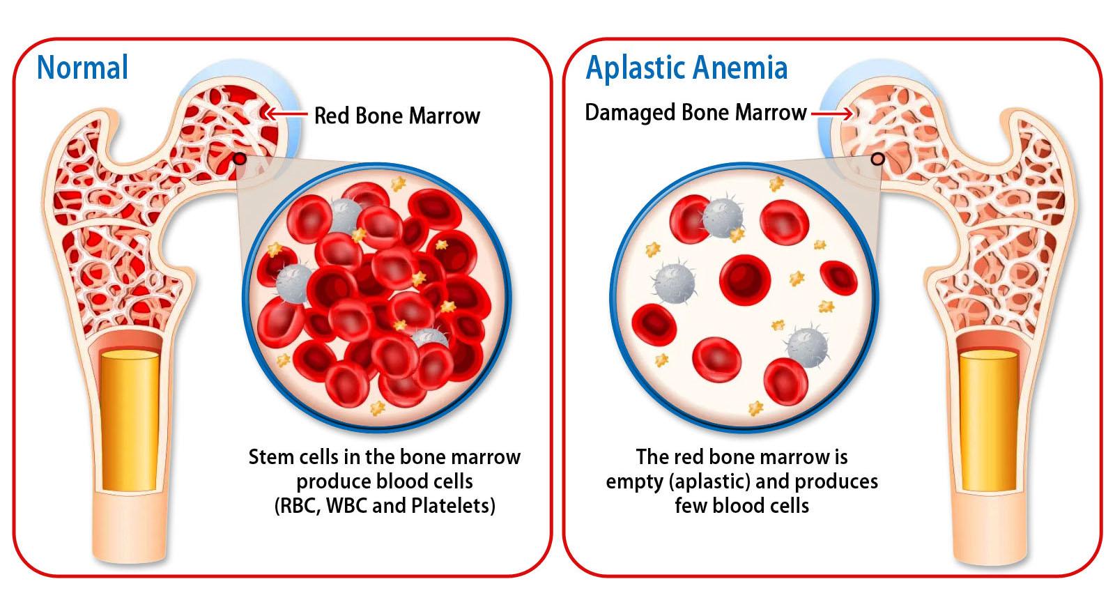 Aplastic anemia Look like 